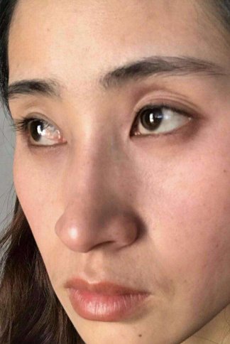 去眼袋手术