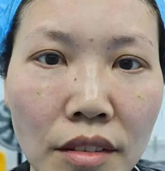 去眼袋手术