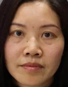 去眼袋手术