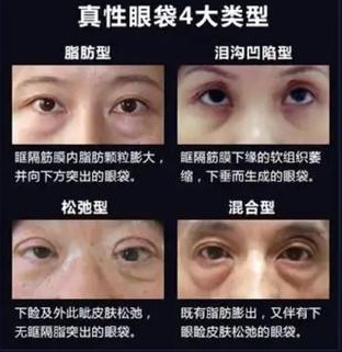 去眼袋手术