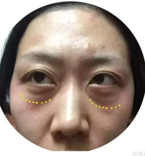 眼袋