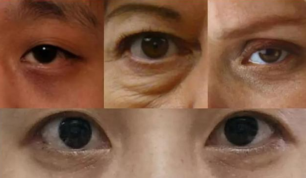 眼袋手术