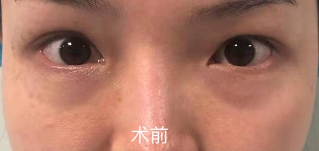 眼袋手术
