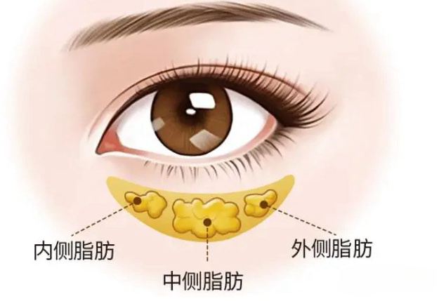 眼袋