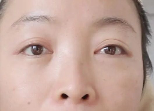 眼袋