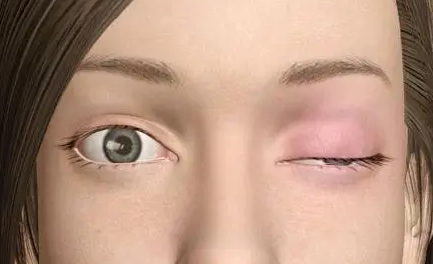 眼袋