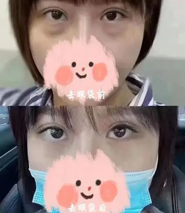眼袋