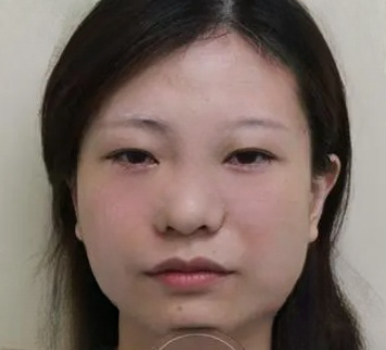 眼袋