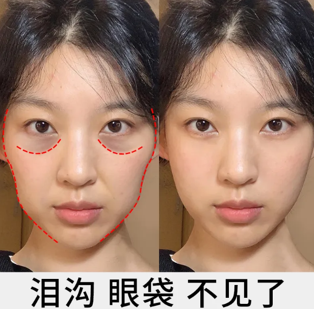 眼袋
