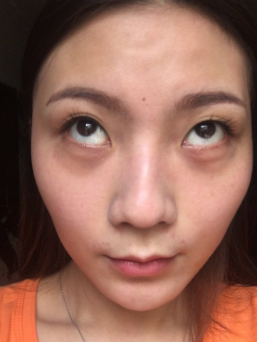 眼袋
