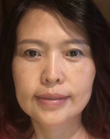 眼袋