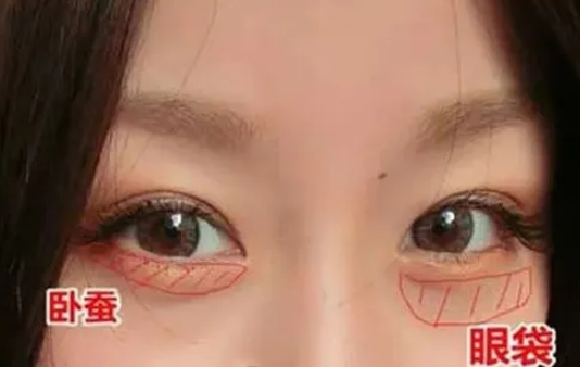 眼袋