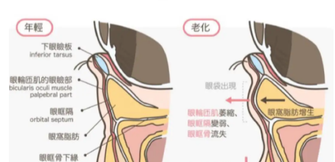 眼袋