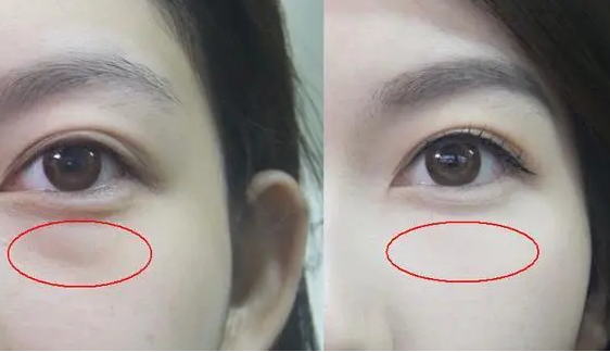 眼袋
