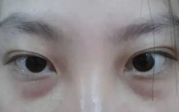 眼袋