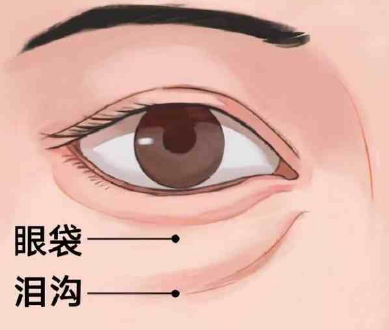 眼袋