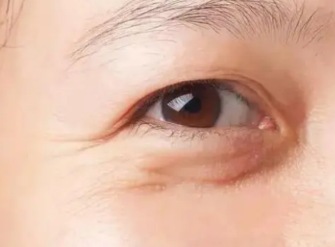 眼袋