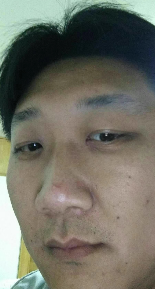 眼袋