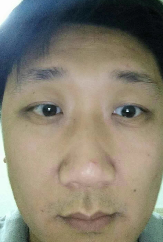 眼袋