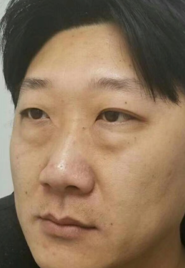 眼袋