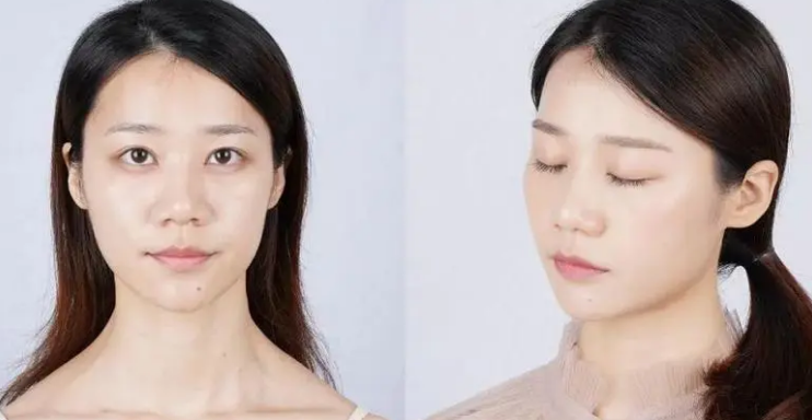 眼袋