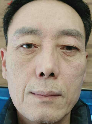 去眼袋手术