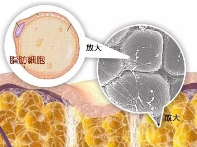 自体脂肪胶填充