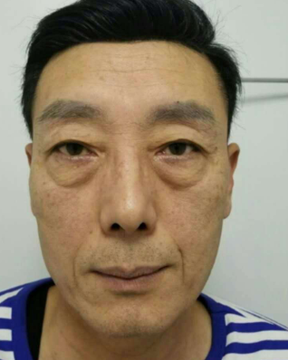 去眼袋手术