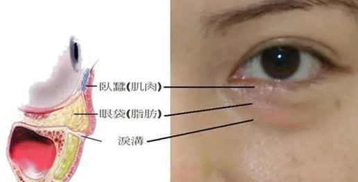 去眼袋手术