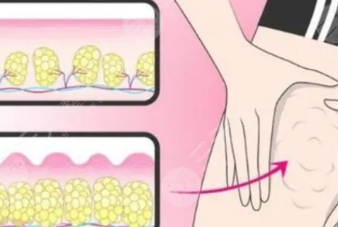 自体脂肪胶填充