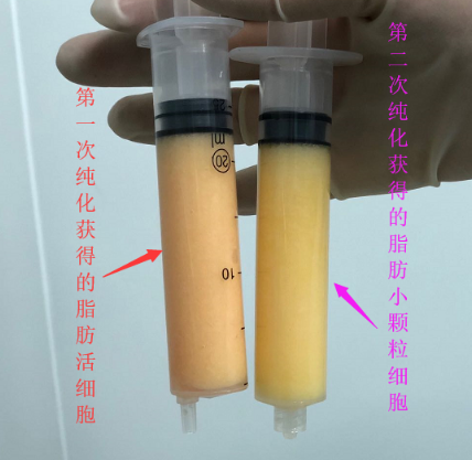 自体脂肪胶填充