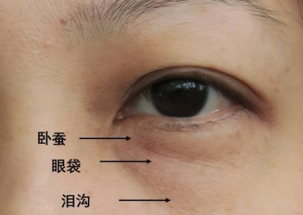 眼袋
