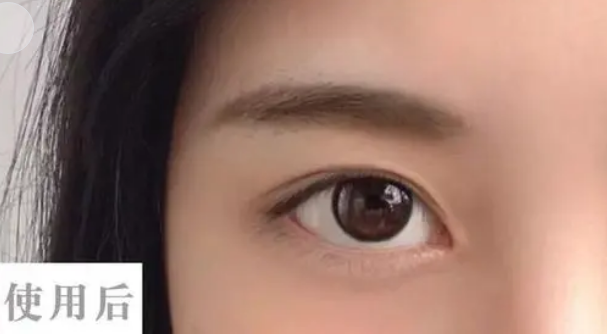 眼袋