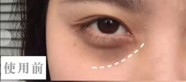 眼袋
