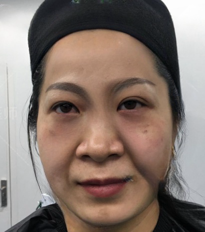 去眼袋手术