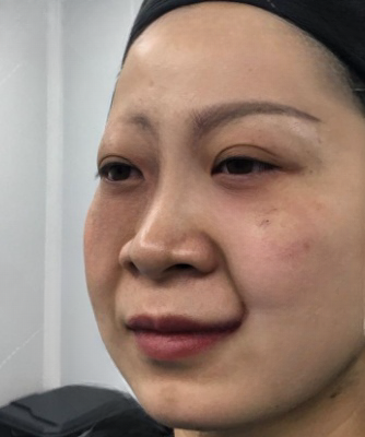 去眼袋手术