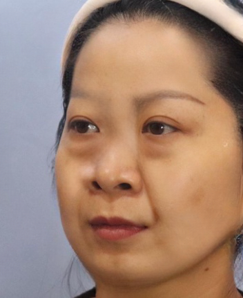 去眼袋手术