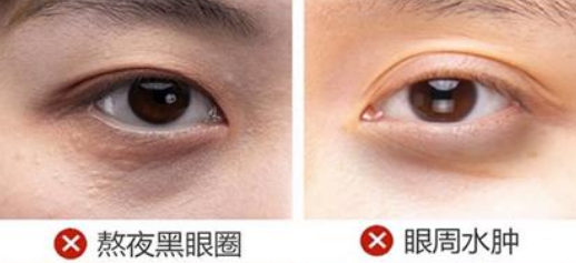 去眼袋手术