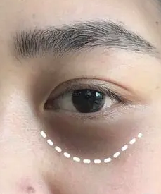 去眼袋手术