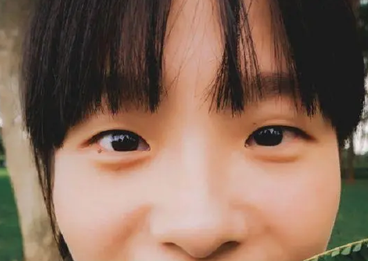 去眼袋手术