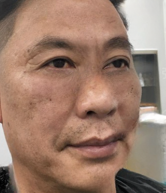 去眼袋手术
