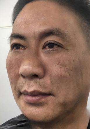 去眼袋手术