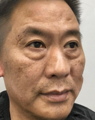 去眼袋手术