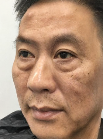 去眼袋手术