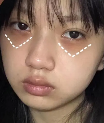 去眼袋手术