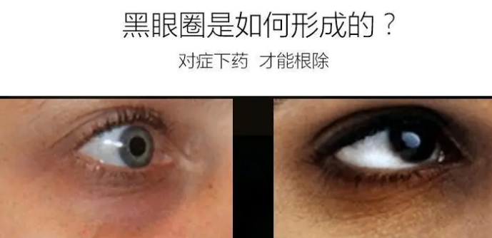 去眼袋手术