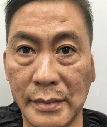 去眼袋手术