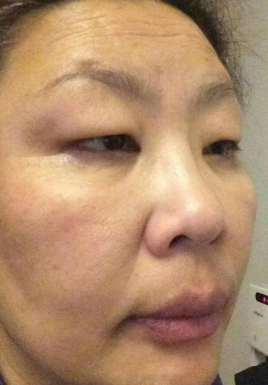 去眼袋手术