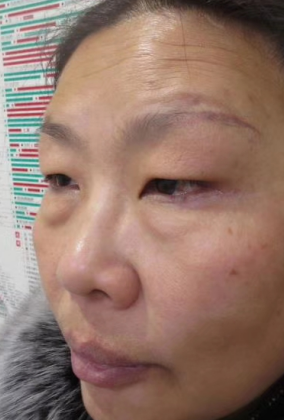 去眼袋手术