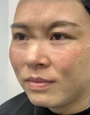 去眼袋手术